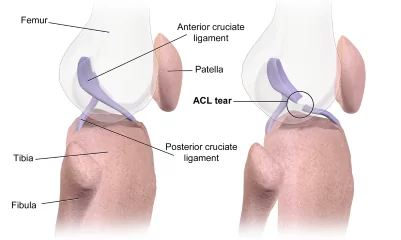ACL_Tear