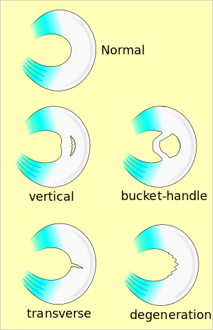 Chart showing different meniscal tears including: vertical, bucket-handle, transverse, degeneration