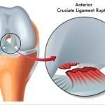 ACL tear shown in detail - click physiotherapy