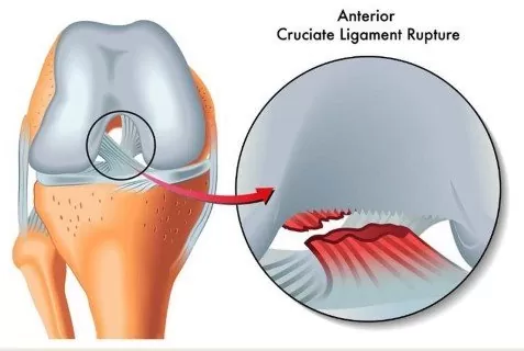 ACL tear - animated showing the inside of ACL tear