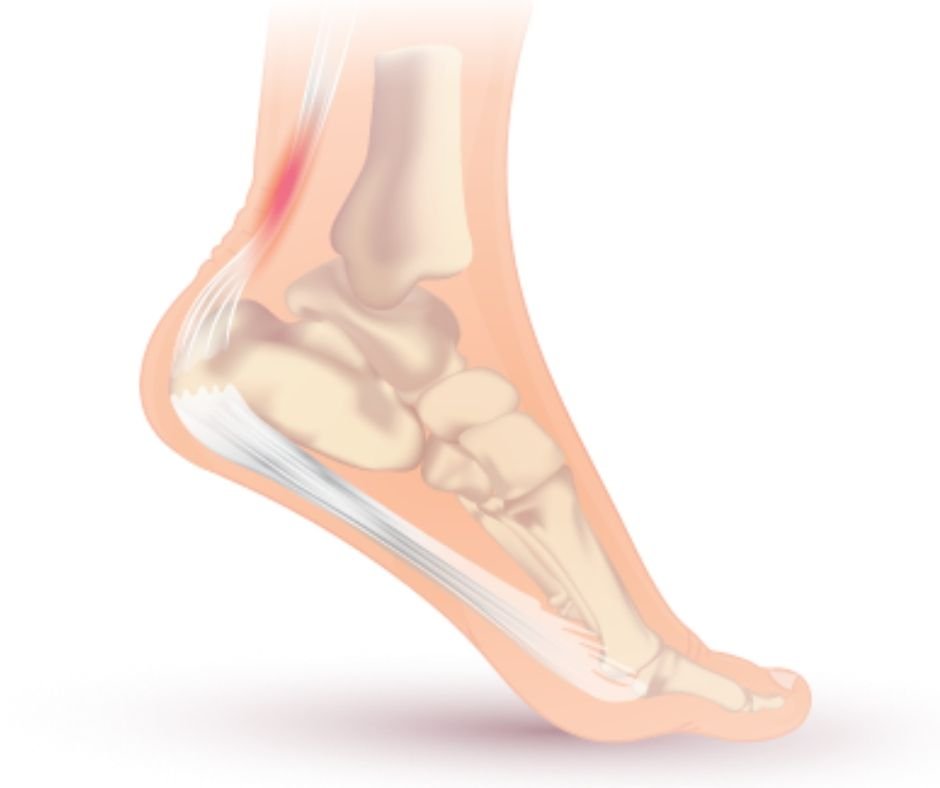 Picture of mid-substance Achilles Tendinopathy.. Click Physiotherapy.