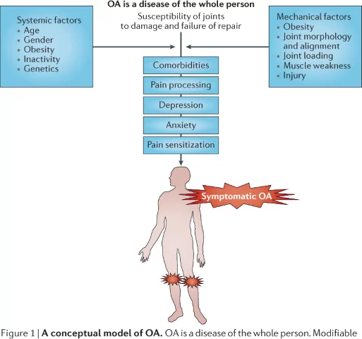 Picture of different systemic and mechanical factors that contribute to knee osteoarthritis.