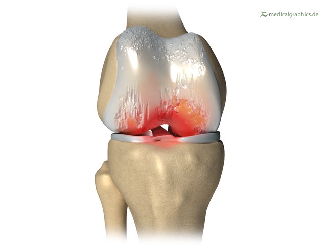 The illustration shows a slightly bent knee (front) with the following structures: femur, fibula, tibia. Extensively degraded articular cartilage. Inflammation of the entire joint.