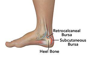 achille-tendon-bursitis