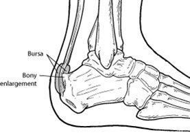 haglunds deformity