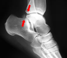 post-ankle-impingement